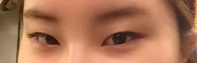 我只是做了開眼角，眼睛就變成這樣了。