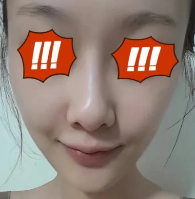 我是大約一個月前做了脂肪移植的宣美。大家過得還好嗎？