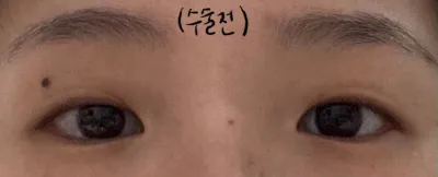 埋線+開眼頭後記