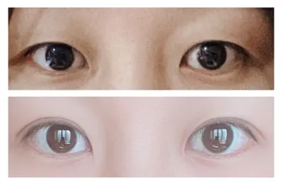 雙眼皮3個月後記