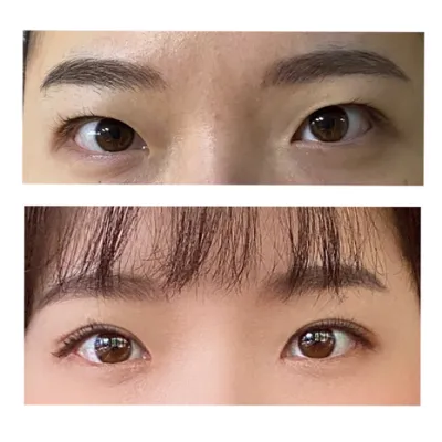 雙眼皮埋線 + 開眼頭 2個月後記！