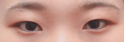 割雙眼皮+開眼頭手術一個月後