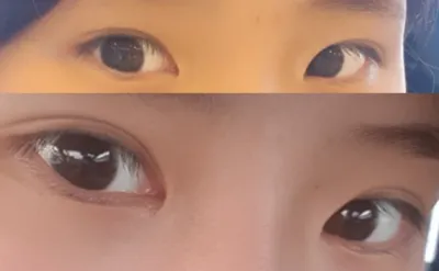 開眼頭、雙眼皮重修手術2個月後記~