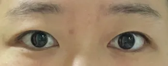 割雙眼皮開眼頭5個月後記