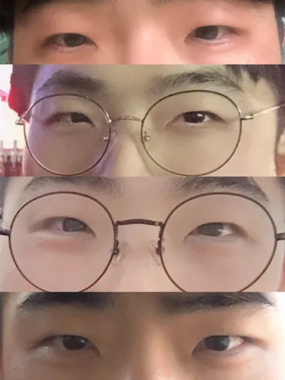 眼型矯正(切開)+開眼頭後記