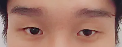 無雙眼型矯正，開眼頭兩週..