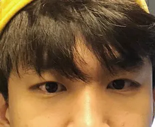 男生眼型矯正1個月後記！