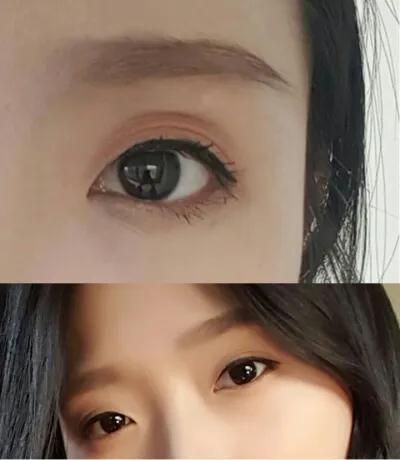 切開眼型矯正+開眼頭+上眼瞼脂肪移植 6個月經過後記