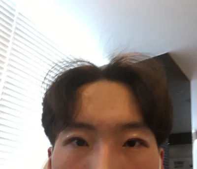 男生切開眼型矯正後記