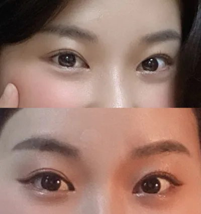 香腸眼重修、開眼頭重修、開眼尾+下至一年後的經過報告來囉