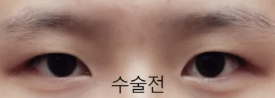 切開眼型矯正+前後下眼瞼下置 真實後記!!