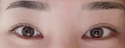 切開眼型矯正，開眼頭兩個月了