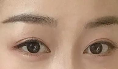 切開眼型矯正、開眼頭6個月後記