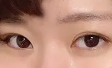 埋線+開眼頭一個月啦!!!!