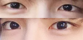 男生無雙眼型矯正，開眼頭後記