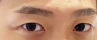 無雙眼型矯正一個月後