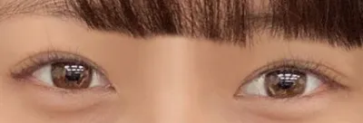 終於做眼睛了～