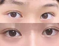 雙眼皮重修