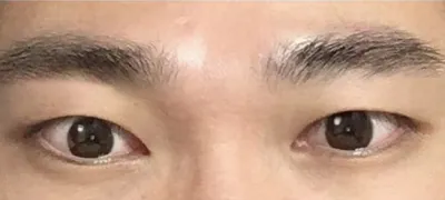 男生無雙眼型矯正