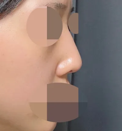 我做了鼻中隔矯正術+下鼻甲切除術的功能性鼻整形！