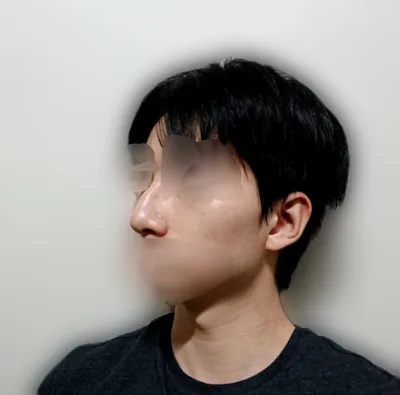 隨著消腫，鼻子變得既自然又精緻漂亮，非常滿意。