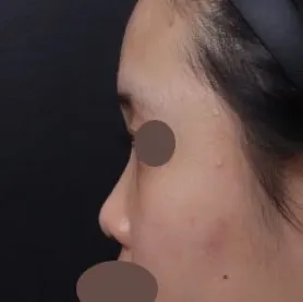 大家快去 Very Good 整形外科做隆鼻吧！