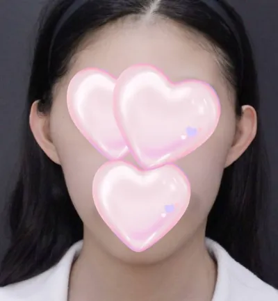 自費做了顴骨、下巴縮小及下巴前移手術～