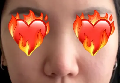 因為很在意蒜頭鼻，所以在 Very Good 做了鼻整形手術。