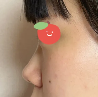 去了7家以上標榜能做功能性隆鼻的診所都說不行，但Very Good整形外科說連鼻竇炎也可以處理，解說也很詳盡，所以就簽約了。