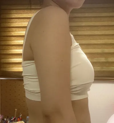 哇...手臂兩側的脂肪真的都被切掉了呢..！太滿意了 ㅠㅠㅠ