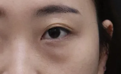 因為是重修手術，所以更加謹慎地到處諮詢比較，但崔賢貞室長和金勇宇院長講解得非常仔細，也讓我感到很安心，所以最後決定在這裡做。