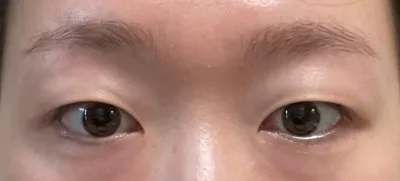 手術前後的印象變了很多，我非常滿意。