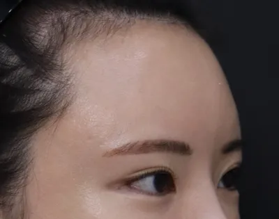 手術當天雖然有點痛，但效果很好，真的很滿意！眼睛和眉毛之間的距離變寬了，額頭也變窄了～^^