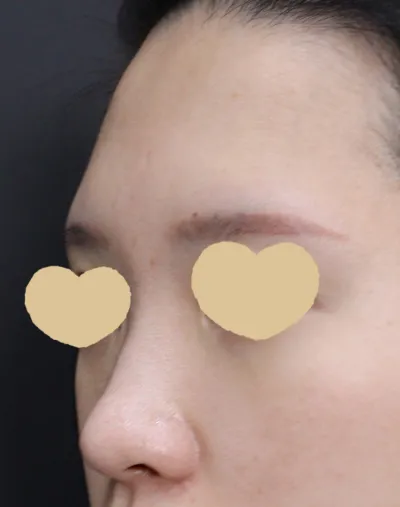 我第一次隆鼻手術選擇的醫院，是看到模特兒後就完全被吸引住的 Very Good 整形外科 :)