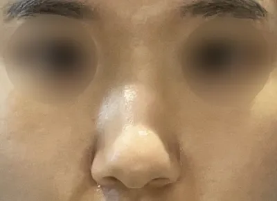 手術至今已過兩個月，我感到非常滿意，完全沒有副作用，目前過得很好。