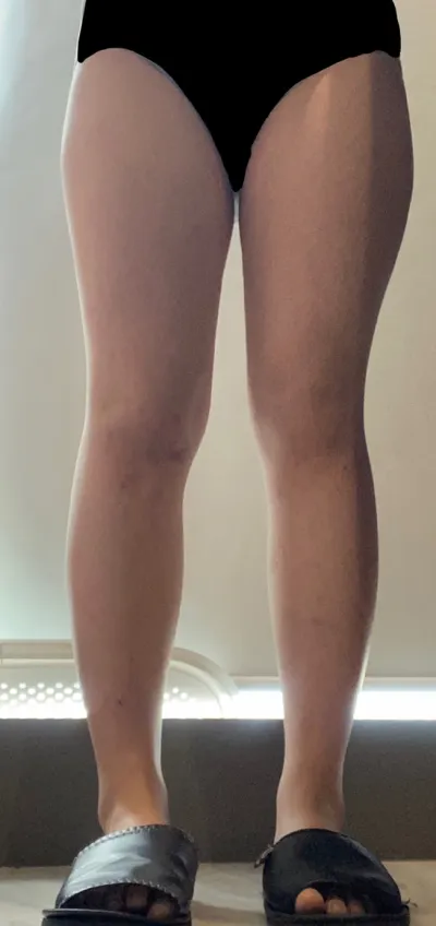 我嘗試過非常多種減肥方法，但每次唯獨大腿的肉瘦不下來，真的讓我壓力很大，抽脂才是唯一的答案。