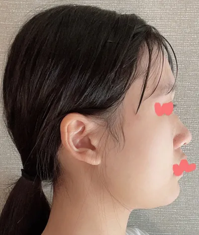 非常滿意，自尊心也大幅提升了。還在猶豫要不要做隆鼻的人，我覺得直接去做比較好。