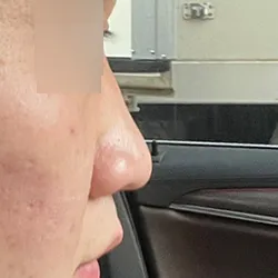 塌鼻子和寬鼻子曾是我的自卑來源，但以術後恢復時間來看，我現在已經非常滿意了。