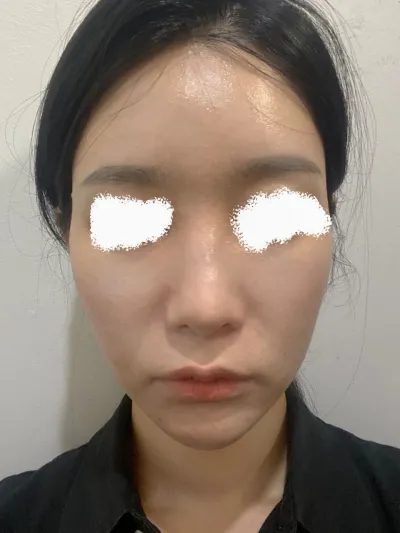 去年在院長那裡做了長曲線下頜角，非常滿意，所以