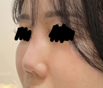 手術結果真的非常滿意，院長真是神手.. ^^*