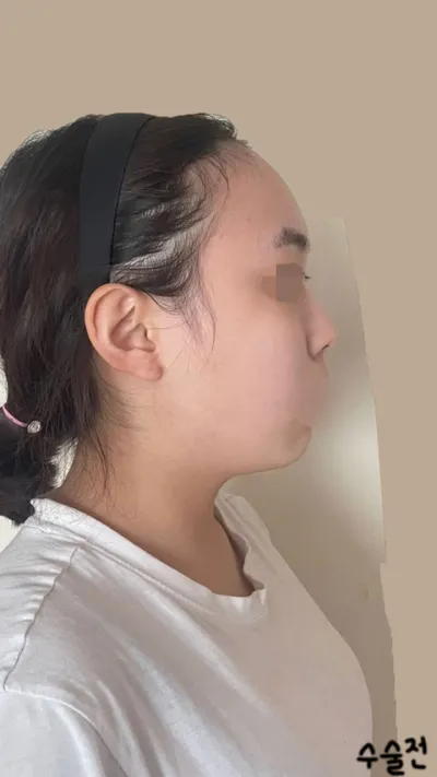 手術後三個月的心得！