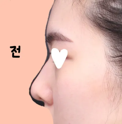 在 Very Good 整形外科做隆鼻手術（初次隆鼻）已經第2週了！