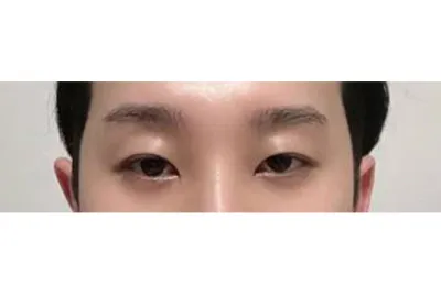 這是手術後6個月的心得。