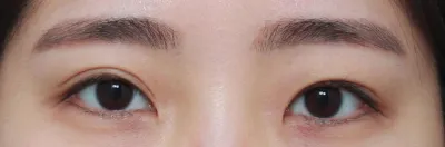 眼部整形（眼部修復）三個月心得,,,