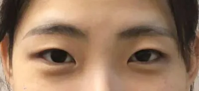 今年4月20日進行了眼部整形（初眼），以非切開方式進行了雙眼皮（自然黏連）和眼型矯正手術。