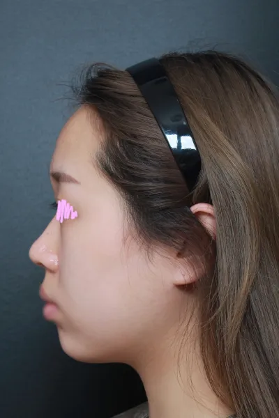 從諮詢到手術都非常仔細且親切，真的太棒了 ㅠㅠ