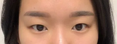 因為太想擁有雙眼皮大眼睛，所以去做了雙眼皮手術！