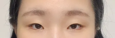 終於做了期待已久的雙眼皮手術。