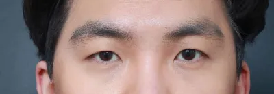 男生眼睛整形，現在有自信了哈