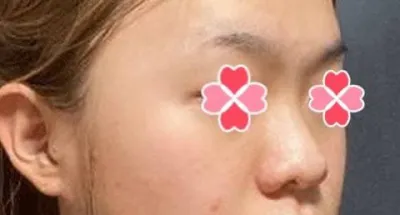 做完隆鼻手術後，常聽到別人說我整體的印象變好了。呵